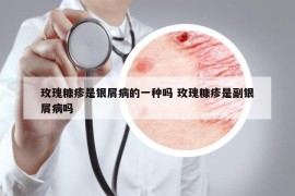 玫瑰糠疹是銀屑病的一種嗎 玫瑰糠疹是副銀屑病嗎