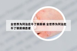 全世界為何治愈不了銀屑病 全世界為何治愈不了銀屑病患者