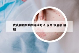 皮炎和銀屑病的確診方法 皮炎 銀屑病 區(qū)別
