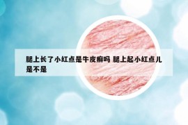腿上長了小紅點(diǎn)是牛皮癬嗎 腿上起小紅點(diǎn)兒是不是