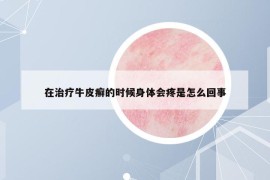 在治療牛皮癬的時候身體會疼是怎么回事