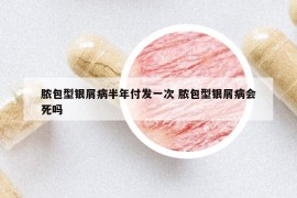 膿包型銀屑病半年付發(fā)一次 膿包型銀屑病會(huì)死嗎