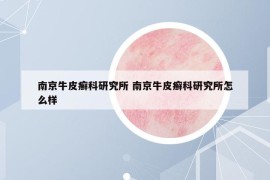 南京牛皮癬科研究所 南京牛皮癬科研究所怎么樣