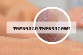 掌跖膿皰吃什么藥 掌跖膿皰吃什么藥最好