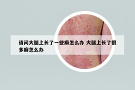 請問大腿上長了一些癬怎么辦 大腿上長了很多癬怎么辦