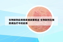 生物制劑應用銀屑病簡要概述 生物制劑在銀屑病治療中的應用