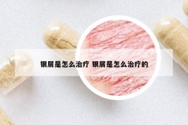 銀屑是怎么治療 銀屑是怎么治療的