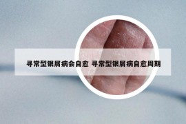 尋常型銀屑病會自愈 尋常型銀屑病自愈周期