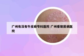 廣州有沒(méi)有牛皮癬專科醫(yī)院 廣州看銀屑病醫(yī)院