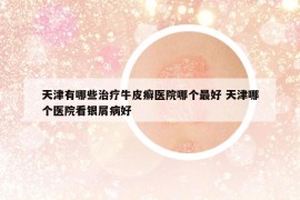 天津有哪些治療牛皮癬醫(yī)院哪個(gè)最好 天津哪個(gè)醫(yī)院看銀屑病好