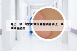 身上一塊一塊的紅塊而且有鱗屑 身上一塊一塊紅色起皮
