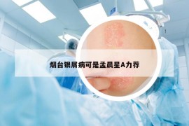 煙臺銀屑病可是孟晨星A力薦