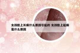 女孩臉上長癬什么原因引起的 女孩臉上起癬是什么原因