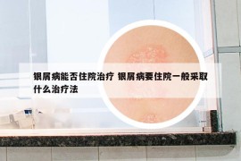 銀屑病能否住院治療 銀屑病要住院一般采取什么治療法