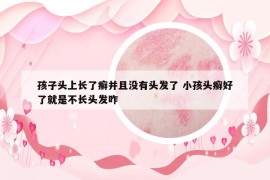 孩子頭上長了癬并且沒有頭發(fā)了 小孩頭癬好了就是不長頭發(fā)咋