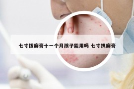 七寸撥癬膏十一個月孩子能用嗎 七寸扒癬膏
