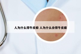 人為什么得牛皮癬 人為什么會得牛皮廨