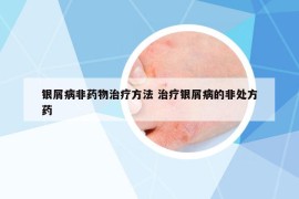銀屑病非藥物治療方法 治療銀屑病的非處方藥