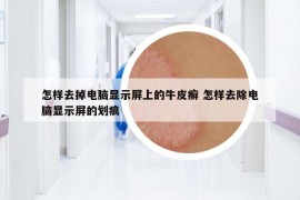 怎樣去掉電腦顯示屏上的牛皮癬 怎樣去除電腦顯示屏的劃痕