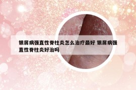 銀屑病強直性脊柱炎怎么治療最好 銀屑病強直性脊柱炎好治嗎