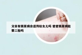 父親有銀屑病會(huì)遺傳給女兒嗎 爸爸銀屑病能要二胎嗎