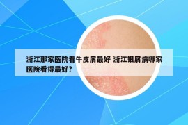 浙江那家醫(yī)院看牛皮屑最好 浙江銀屑病哪家醫(yī)院看得最好?