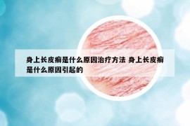 身上長皮癬是什么原因治療方法 身上長皮癬是什么原因引起的