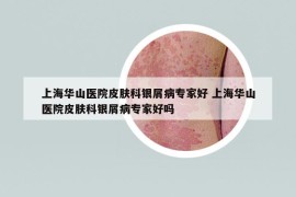 上海華山醫(yī)院皮膚科銀屑病專家好 上海華山醫(yī)院皮膚科銀屑病專家好嗎