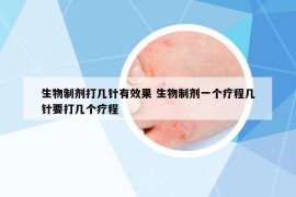 生物制劑打幾針有效果 生物制劑一個療程幾針要打幾個療程
