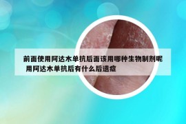 前面使用阿達(dá)木單抗后面該用哪種生物制劑呢 用阿達(dá)木單抗后有什么后遺癥