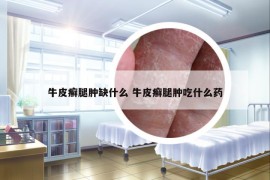牛皮癬腿腫缺什么 牛皮癬腿腫吃什么藥