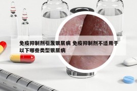 免疫抑制劑引發(fā)銀屑病 免疫抑制劑不適用于以下哪些類型銀屑病