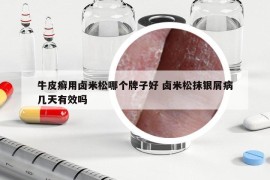 牛皮癬用鹵米松哪個牌子好 鹵米松抹銀屑病幾天有效嗎