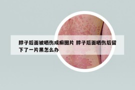 脖子后面被曬傷成癬圖片 脖子后面曬傷后留下了一片黑怎么辦