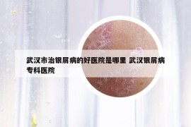 武漢市治銀屑病的好醫(yī)院是哪里 武漢銀屑病?？漆t(yī)院