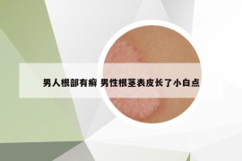 男人根部有癬 男性根莖表皮長了小白點