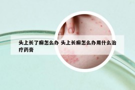 頭上長(zhǎng)了癬怎么辦 頭上長(zhǎng)癬怎么辦用什么治療藥膏