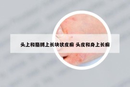 頭上和胳膊上長(zhǎng)塊狀皮癬 頭皮和身上長(zhǎng)癬