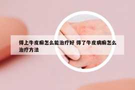 得上牛皮癬怎么能治療好 得了牛皮病癬怎么治療方法