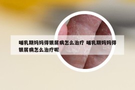 哺乳期媽媽得銀屑病怎么治療 哺乳期媽媽得銀屑病怎么治療呢