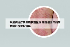 銀屑病治療的生物制劑醫(yī)保 銀屑病治療的生物制劑醫(yī)保報銷嗎