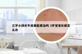 三歲小孩長牛皮癬能根治嗎 3歲寶寶長癬怎么辦