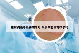 銀屑病能不能要孩子嗎 銀屑病能生育孩子嗎