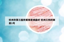 杭州市第三醫(yī)院看銀屑病最好 杭州三院的銀屑1號(hào)