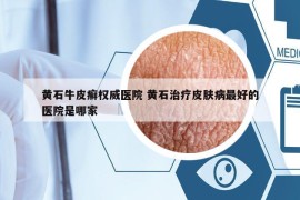 黃石牛皮癬權(quán)威醫(yī)院 黃石治療皮膚病最好的醫(yī)院是哪家