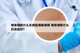 銀屑病擦什么東西能緩解病情 銀屑病擦什么藥膏能好?
