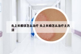 頭上長(zhǎng)癬該怎么治療 頭上長(zhǎng)癬怎么治療土方法