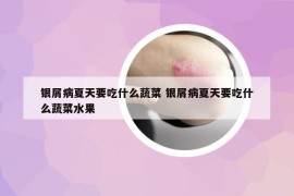 銀屑病夏天要吃什么蔬菜 銀屑病夏天要吃什么蔬菜水果