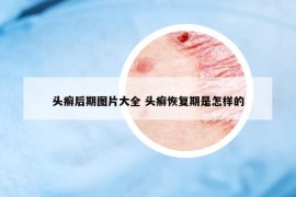 頭癬后期圖片大全 頭癬恢復(fù)期是怎樣的