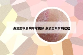 點滴型銀屑病專家視頻 點滴型銀屑病過程